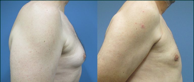 Gynaecomastia (male breast reduction) before and after, 90° right view, male patient, case GYN-L05, Dr Rohit Kumar, Sydney
