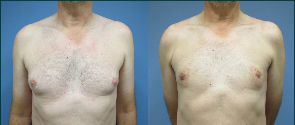 Gynaecomastia (male breast reduction) before and after, front view, male patient, case GYN-L05, Dr Rohit Kumar, Sydney