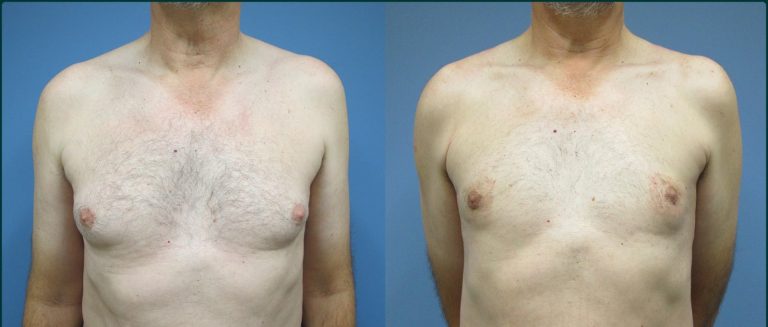 Gynaecomastia (male breast reduction) before and after, front view, male patient, case GYN-L05, Dr Rohit Kumar, Sydney