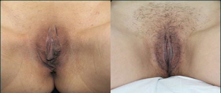 Labiaplasty before and after, front view, female patient, case LAB-L01, Dr Rohit Kumar, Sydney