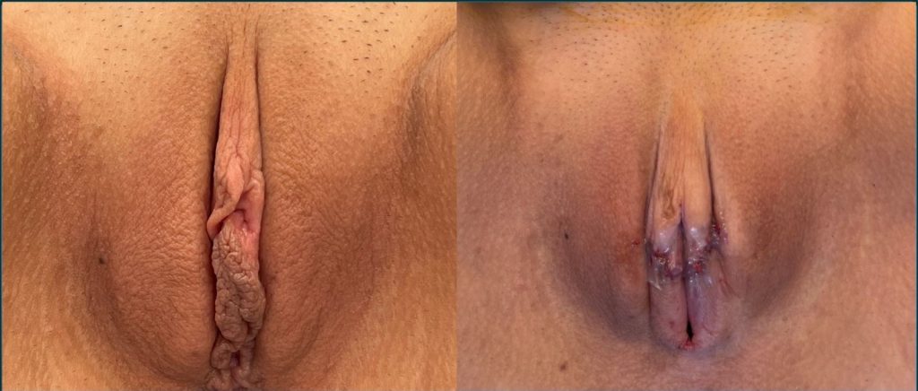 Labiaplasty before and after, female patient, case LAB-L02, Dr Rohit Kumar, Sydney
