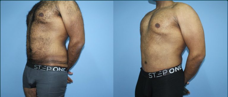 Skin removal after weight loss (male) before and after, 45° left view, male patient, case LBL-L17, Dr Rohit Kumar, Sydney