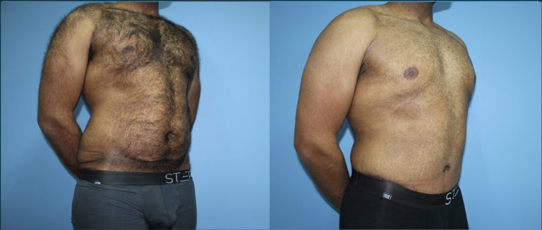 Skin removal after weight loss (male) before and after, 45° right view, male patient, case LBL-L17, Dr Rohit Kumar, Sydney