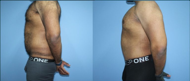Skin removal after weight loss (male) before and after, 90° left view, male patient, case LBL-L17, Dr Rohit Kumar, Sydney