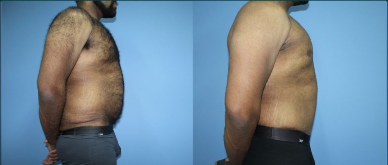 Skin removal after weight loss (male) before and after, 90° right view, male patient, case LBL-L17, Dr Rohit Kumar, Sydney