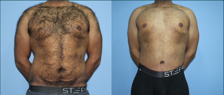 Skin removal after weight loss (male) before and after, front view, male patient, case LBL-L17, Dr Rohit Kumar, Sydney