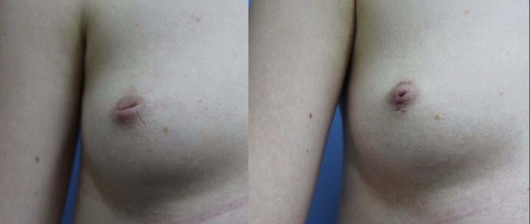 Nipple and areola surgery before and after, 90° right view, female patient, case NAS-L01, Dr Rohit Kumar, Sydney