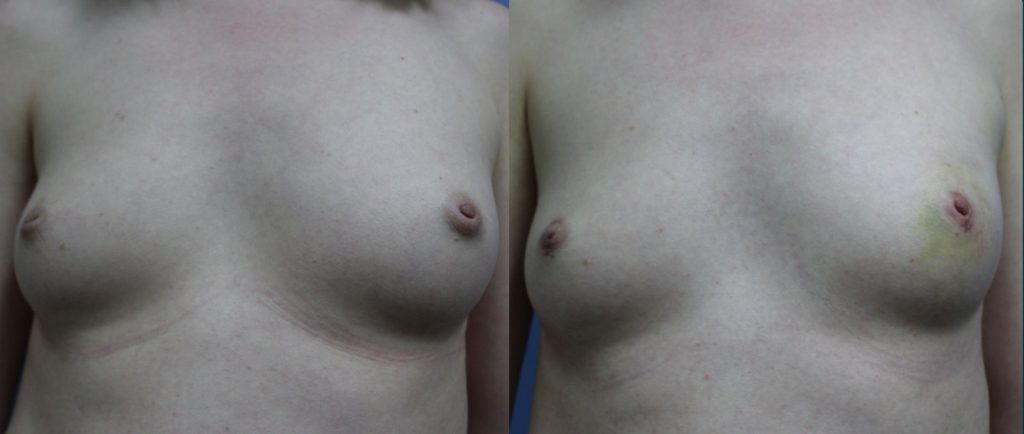 Nipple and areola surgery before and after, front view, female patient, case NAS-L01, Dr Rohit Kumar, Sydney