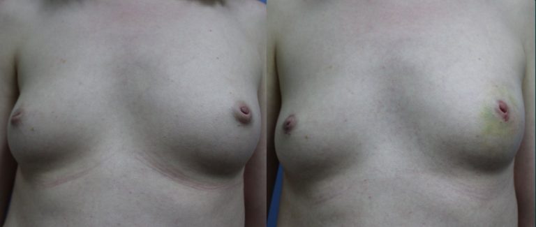 Nipple and areola surgery before and after, front view, female patient, case NAS-L01, Dr Rohit Kumar, Sydney