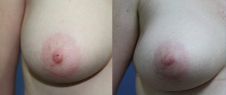 Nipple and areola surgery before and after, 90° left view, female patient, case NAS-L02, Dr Rohit Kumar, Sydney
