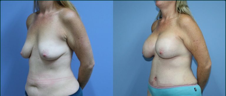 Post-pregnancy surgery before and after, 45° left view, female patient, case PPS-L01, Dr Rohit Kumar, Sydney