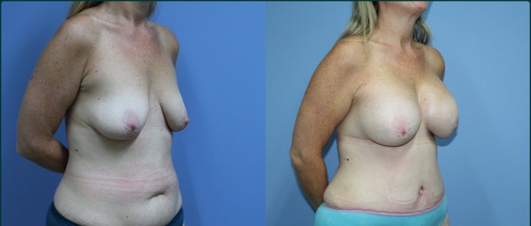 Post-pregnancy surgery before and after, 45° right view, female patient, case PPS-L01, Dr Rohit Kumar, Sydney