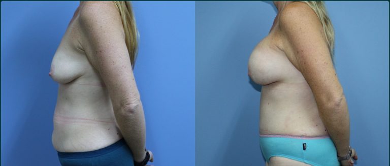 Post-pregnancy surgery before and after, 90° left view, female patient, case PPS-L01, Dr Rohit Kumar, Sydney