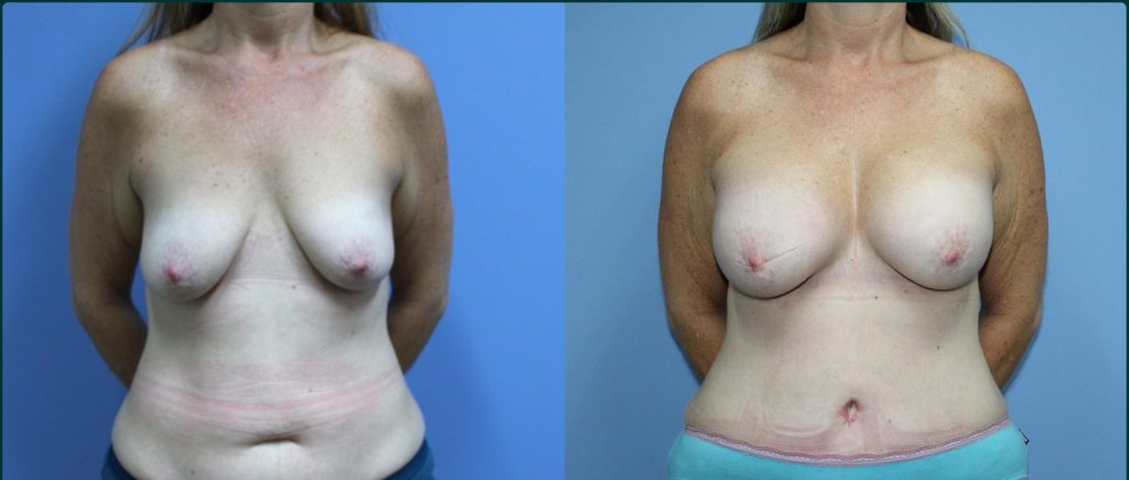 Post-pregnancy surgery before and after, front view, female patient, case PPS-L01, Dr Rohit Kumar, Sydney