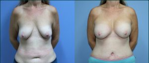 Penrith 5 Post-pregnancy surgery before and after, front view, case PPS-L01, Dr Rohit Kumar
