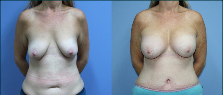 Post-pregnancy surgery before and after, front view, female patient, case PPS-L01, Dr Rohit Kumar, Sydney