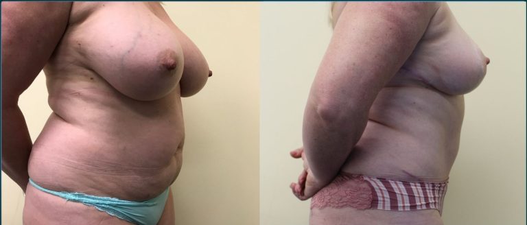 Post-pregnancy surgery before and after, 90° left view, female patient, case PPS-L02, Dr Rohit Kumar, Sydney
