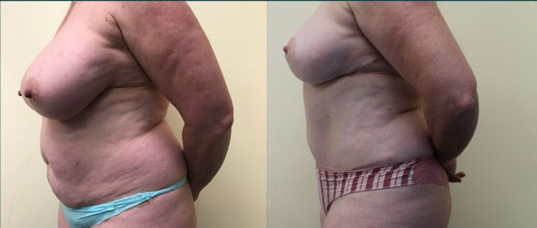 Post-pregnancy surgery before and after, 90° right view, female patient, case PPS-L02, Dr Rohit Kumar, Sydney
