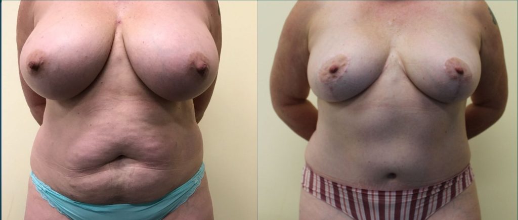 Post-pregnancy surgery before and after, front view, female patient, case PPS-L02, Dr Rohit Kumar, Sydney