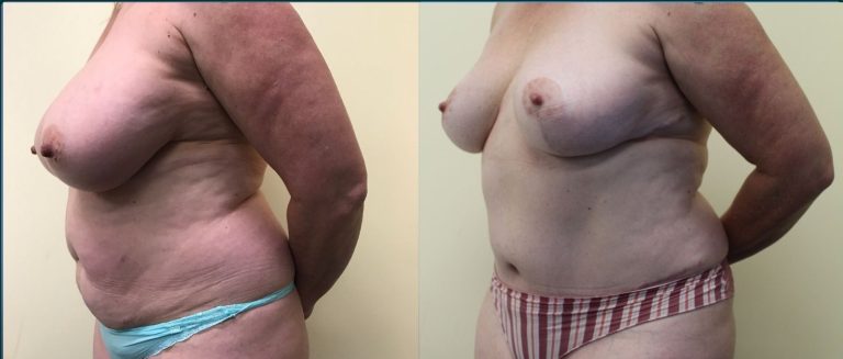 Post-pregnancy surgery before and after, female patient, case PPS-L02, Dr Rohit Kumar, Sydney
