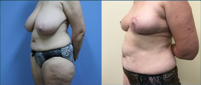 Post-pregnancy surgery before and after, 45° left view, female patient, case PPS-L03, Dr Rohit Kumar, Sydney