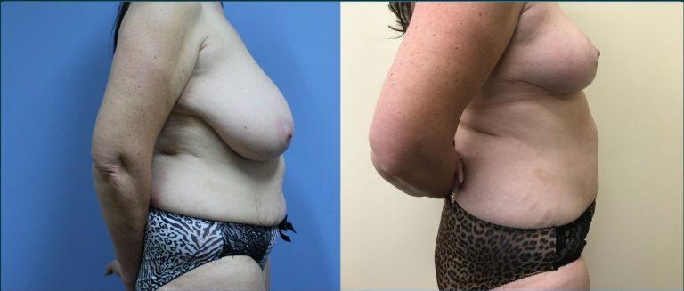 Post-pregnancy surgery before and after, 90° left view, female patient, case PPS-L03, Dr Rohit Kumar, Sydney