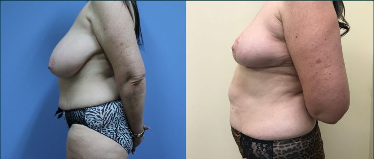 Post-pregnancy surgery before and after, 90° right view, female patient, case PPS-L03, Dr Rohit Kumar, Sydney