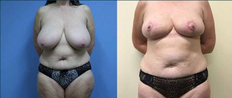 Post-pregnancy surgery before and after, front view, female patient, case PPS-L03, Dr Rohit Kumar, Sydney