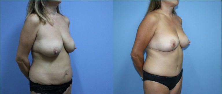 Post-pregnancy surgery before and after, 45° right view, female patient, case PPS-L04, Dr Rohit Kumar, Sydney