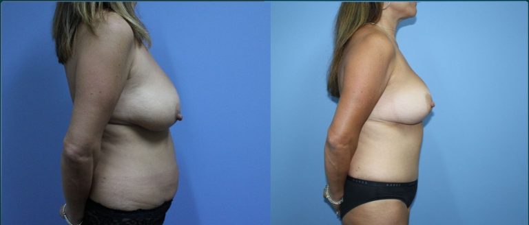 Post-pregnancy surgery before and after, 90° right view, female patient, case PPS-L04, Dr Rohit Kumar, Sydney