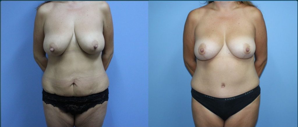Post-pregnancy surgery before and after, front view, female patient, case PPS-L04, Dr Rohit Kumar, Sydney