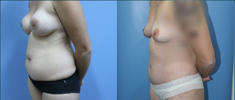 Post-pregnancy surgery before and after, 45° left view, female patient, case PPS-L05, Dr Rohit Kumar, Sydney