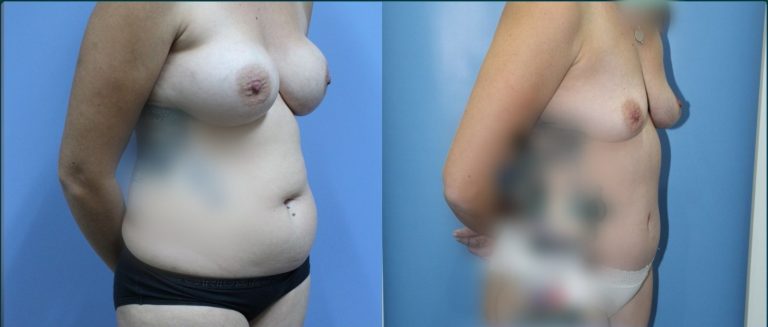 Post-pregnancy surgery before and after, 45° right view, female patient, case PPS-L05, Dr Rohit Kumar, Sydney