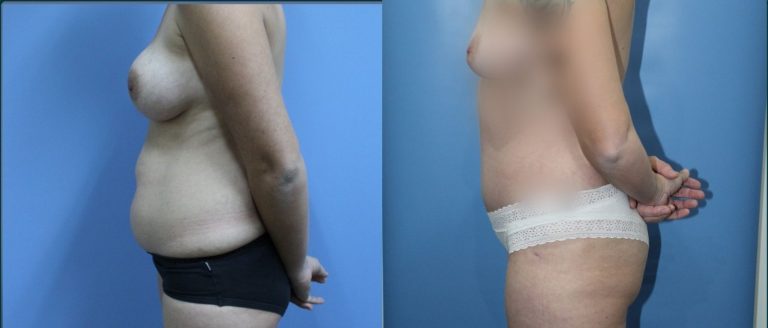 Post-pregnancy surgery before and after, 90° left view, female patient, case PPS-L05, Dr Rohit Kumar, Sydney