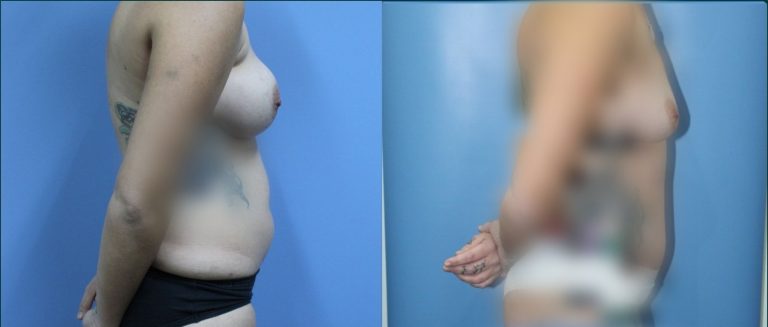 Post-pregnancy surgery before and after, 90° right view, female patient, case PPS-L05, Dr Rohit Kumar, Sydney