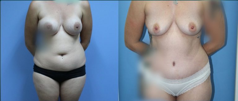 Post-pregnancy surgery before and after, front view, female patient, case PPS-L05, Dr Rohit Kumar, Sydney