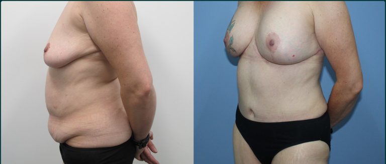 Post-pregnancy surgery before and after, 90° left view, female patient, case PPS-L06, Dr Rohit Kumar, Sydney
