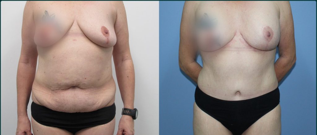 Post-pregnancy surgery before and after, front view, female patient, case PPS-L06, Dr Rohit Kumar, Sydney