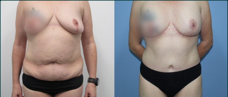 Post-pregnancy surgery before and after, front view, female patient, case PPS-L06, Dr Rohit Kumar, Sydney