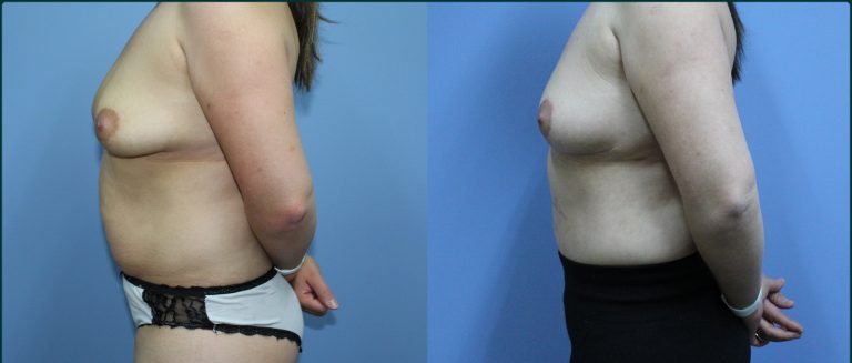 Post-pregnancy surgery before and after, 90° left view, female patient, case PPS-L07, Dr Rohit Kumar, Sydney