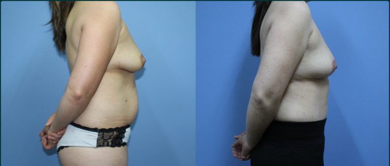 Post-pregnancy surgery before and after, 90° right view, female patient, case PPS-L07, Dr Rohit Kumar, Sydney