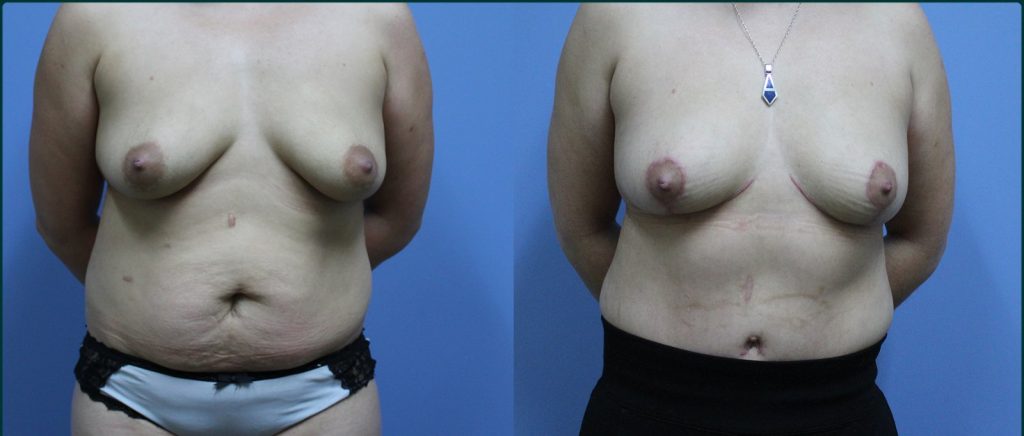 Post-pregnancy surgery before and after, front view, female patient, case PPS-L07, Dr Rohit Kumar, Sydney