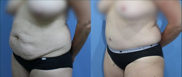 Post-pregnancy surgery before and after, 45° left view, female patient, case PPS-L08, Dr Rohit Kumar, Sydney