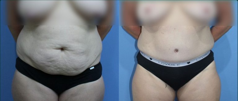 Post-pregnancy surgery before and after, front view, female patient, case PPS-L08, Dr Rohit Kumar, Sydney