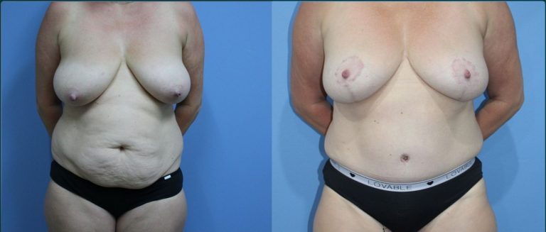 Post-pregnancy surgery before and after, front view, female patient, case PPS-L08, Dr Rohit Kumar, Sydney