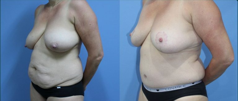 Post-pregnancy surgery before and after, female patient, case PPS-L08, Dr Rohit Kumar, Sydney