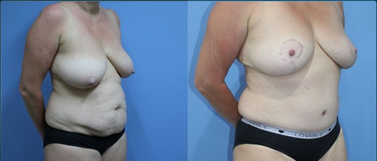 Post-pregnancy surgery before and after, female patient, case PPS-L08, Dr Rohit Kumar, Sydney