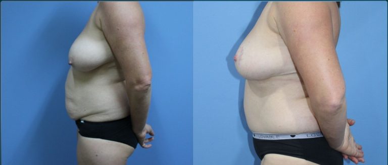 Post-pregnancy surgery before and after, female patient, case PPS-L08, Dr Rohit Kumar, Sydney