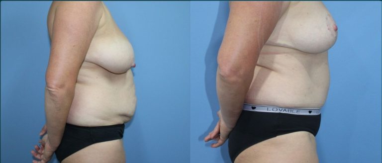 Post-pregnancy surgery before and after, female patient, case PPS-L08, Dr Rohit Kumar, Sydney