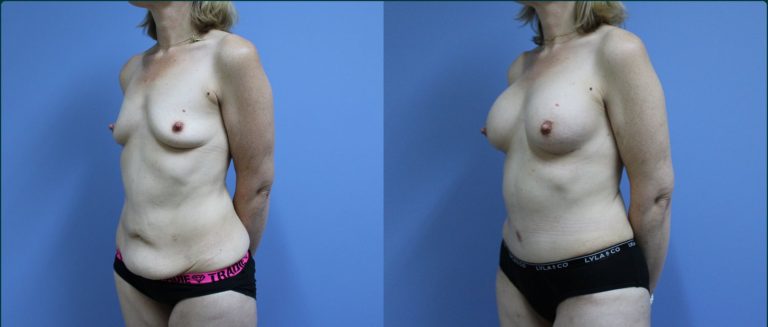 Post-pregnancy surgery before and after, 45° left view, female patient, case PPS-L09, Dr Rohit Kumar, Sydney